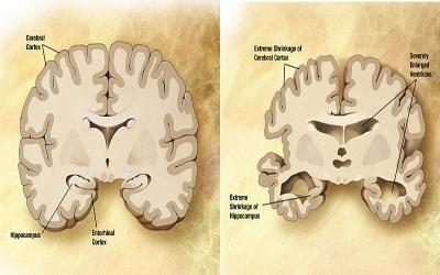 Internationale Dag tegen Alzheimer